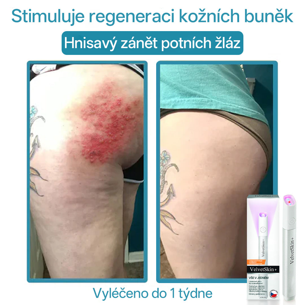 ✨ Bikenda® – CO₂ laserové pero na odstraňování 🟤 mateřských znamének, 🦠 bradavic, 🔘 skvrn a jiných nedokonalostí pleti