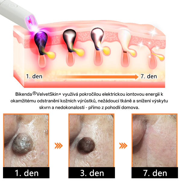 ✨ Bikenda® – CO₂ laserové pero na odstraňování 🟤 mateřských znamének, 🦠 bradavic, 🔘 skvrn a jiných nedokonalostí pleti