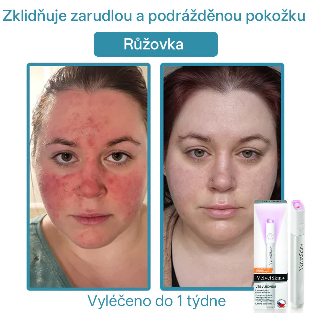 ✨ Bikenda® – CO₂ laserové pero na odstraňování 🟤 mateřských znamének, 🦠 bradavic, 🔘 skvrn a jiných nedokonalostí pleti🩸
