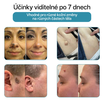 ✨ Bikenda® – CO₂ laserové pero na odstraňování 🟤 mateřských znamének, 🦠 bradavic, 🔘 skvrn a jiných nedokonalostí pleti🩸