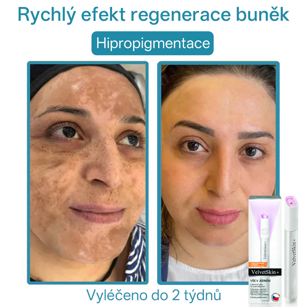 ✨ Bikenda® – CO₂ laserové pero na odstraňování 🟤 mateřských znamének, 🦠 bradavic, 🔘 skvrn a jiných nedokonalostí pleti🩸