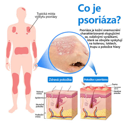【Oficiální značkový obchod】✅Zvoevo® Magnesium bylinný sprej ⚕️ Certifikace MHRA – úleva při psoriáze, ekzému, intimních bakteriálních infekcích, akné a tmavých skvrnách