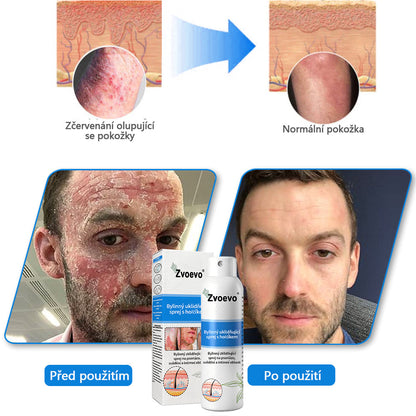 【Oficiální značkový obchod】✅Zvoevo® Magnesium bylinný sprej ⚕️ Certifikace MHRA – úleva při psoriáze, ekzému, intimních bakteriálních infekcích, akné a tmavých skvrnách