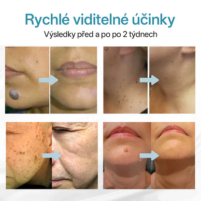 ✨ Bikenda® – CO₂ laserové pero na odstraňování 🟤 mateřských znamének, 🦠 bradavic, 🔘 skvrn a jiných nedokonalostí pleti🩸