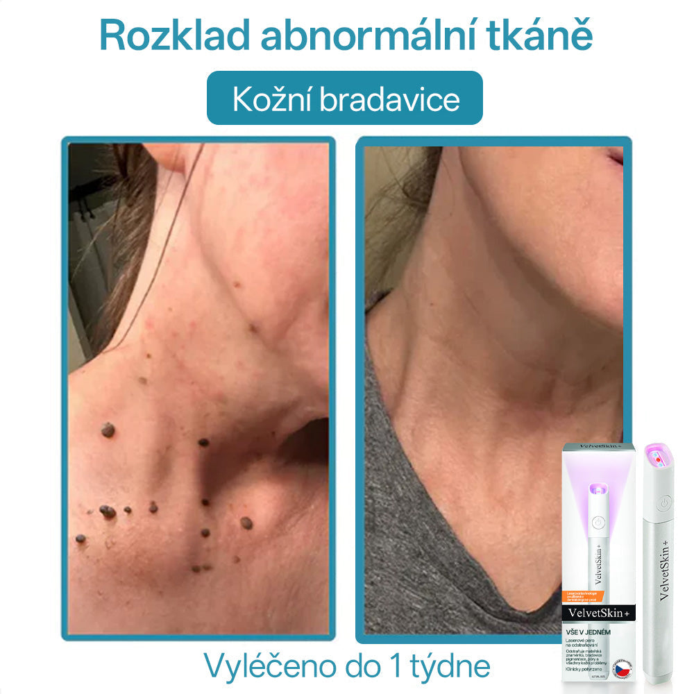 ✨ Bikenda® – CO₂ laserové pero na odstraňování 🟤 mateřských znamének, 🦠 bradavic, 🔘 skvrn a jiných nedokonalostí pleti🩸
